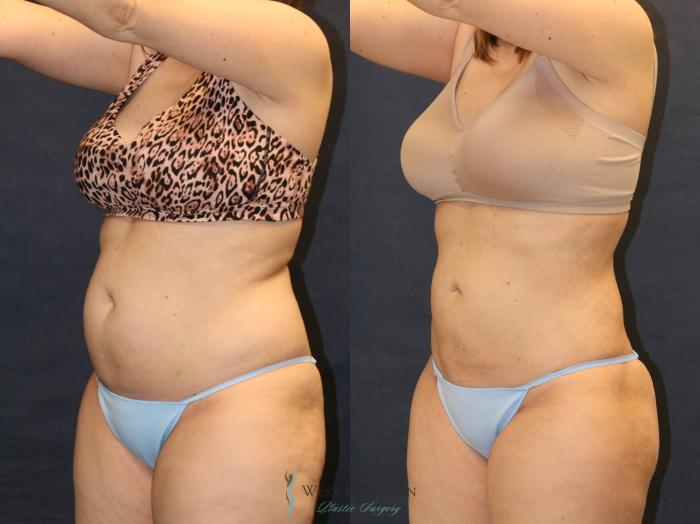Before & After Liposuction Case 9332 Right Oblique View in Portage, Kalamazoo, Battle Creek, Michigan