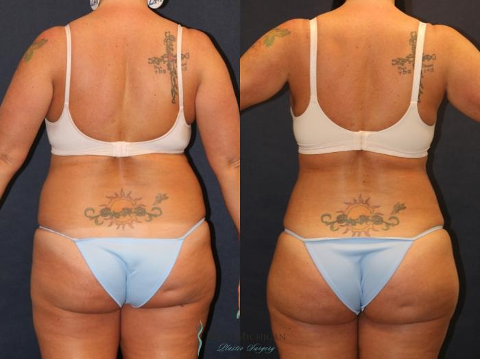 Before & After Liposuction Case 9357 Back View in Portage, Kalamazoo, Battle Creek, Michigan