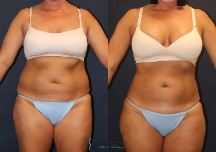 Before & After Liposuction Case 9357 Front View in Portage, Kalamazoo, Battle Creek, Michigan