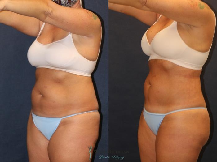 Before & After Liposuction Case 9357 Left Oblique View in Portage, Kalamazoo, Battle Creek, Michigan