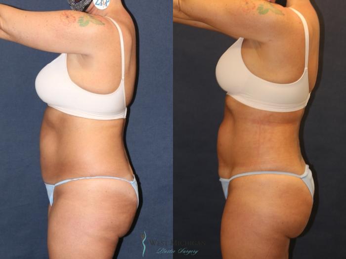 Before & After Liposuction Case 9357 Left Side View in Portage, Kalamazoo, Battle Creek, Michigan