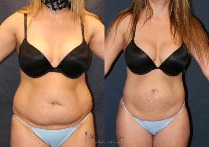 Before & After Liposuction Case 9359 Front View in Portage, Kalamazoo, Battle Creek, Michigan