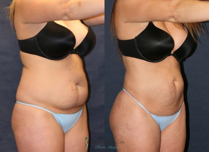 Before & After Liposuction Case 9359 Right Oblique View in Portage, Kalamazoo, Battle Creek, Michigan