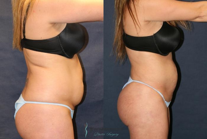 Before & After Liposuction Case 9359 Right Side View in Portage, Kalamazoo, Battle Creek, Michigan