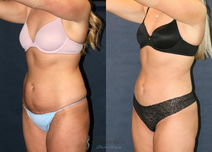 Before & After Liposuction Case 9387 Left Oblique View in Portage, Kalamazoo, Battle Creek, Michigan