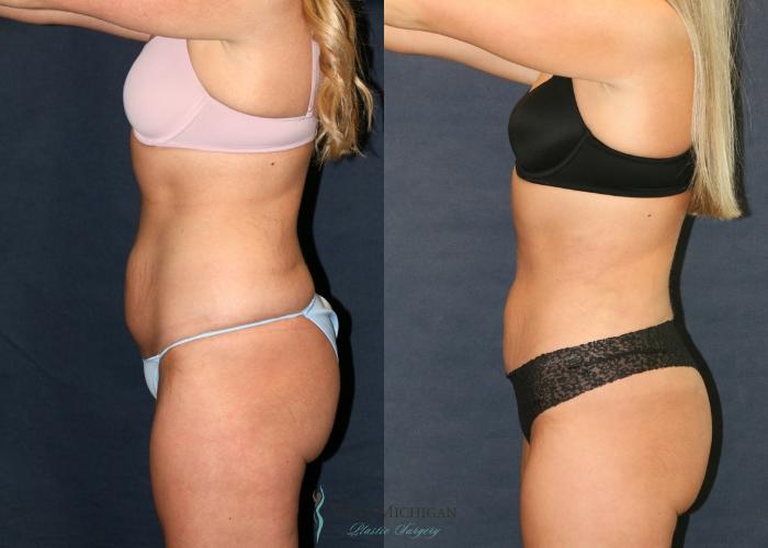 Before & After Liposuction Case 9387 Left Side View in Portage, Kalamazoo, Battle Creek, Michigan