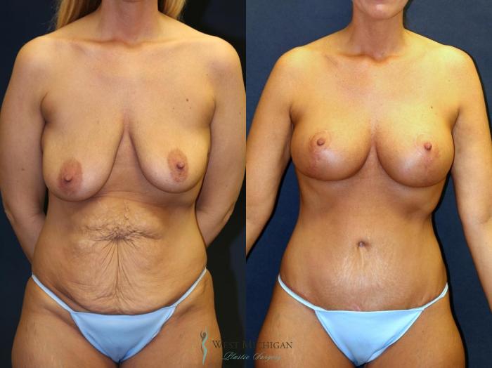 Before & After Tummy Tuck Case 8960 View #1 View in Portage, Kalamazoo, Battle Creek, Michigan