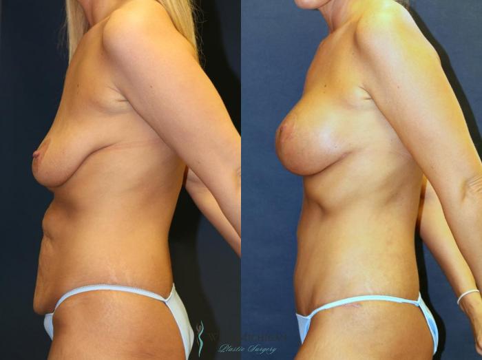 Before & After Breast Augmentation with Lift Case 8960 View #2 View in Portage, Kalamazoo, Battle Creek, Michigan