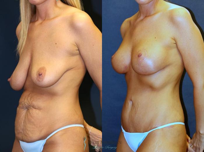 Before & After Breast Augmentation with Lift Case 8960 View #3 View in Portage, Kalamazoo, Battle Creek, Michigan