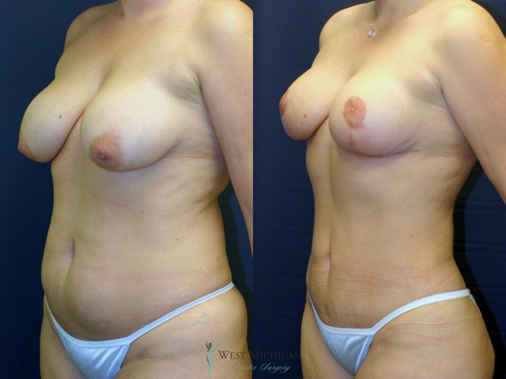 Before & After Mommy Makeover Case 8961 View #2 View in Kalamazoo & Grand Rapids, Michigan