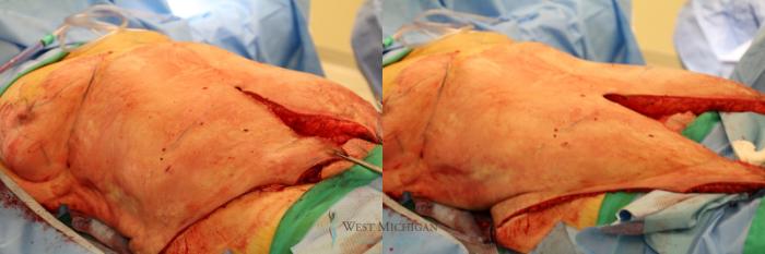 Before & After Mommy Makeover Case 9028 Intraoperative View in Kalamazoo & Grand Rapids, Michigan