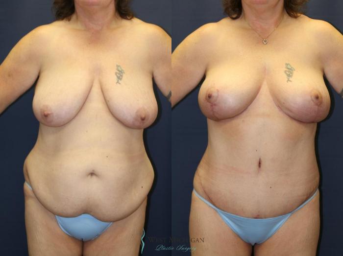 Before & After Mommy Makeover Case 9028 View #1 View in Kalamazoo & Grand Rapids, Michigan