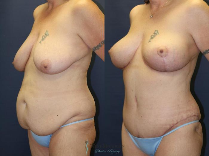 Before & After Mommy Makeover Case 9028 View #3 View in Kalamazoo & Grand Rapids, Michigan