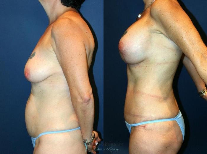 Before & After Mommy Makeover Case 9033 View #2 View in Kalamazoo & Grand Rapids, Michigan