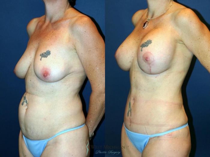 Before & After Mommy Makeover Case 9033 View #3 View in Kalamazoo & Grand Rapids, Michigan