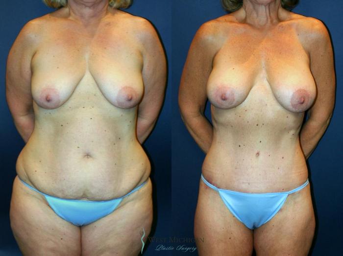 Before & After Mommy Makeover Case 9035 View #1 View in Kalamazoo & Grand Rapids, Michigan