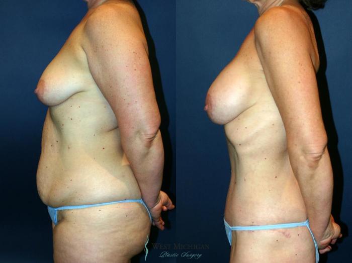 Before & After Mommy Makeover Case 9035 View #2 View in Kalamazoo & Grand Rapids, Michigan