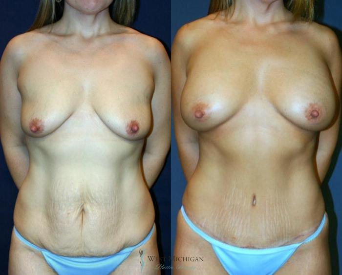 Before & After Mommy Makeover Case 9037 View #3 View in Kalamazoo & Grand Rapids, Michigan