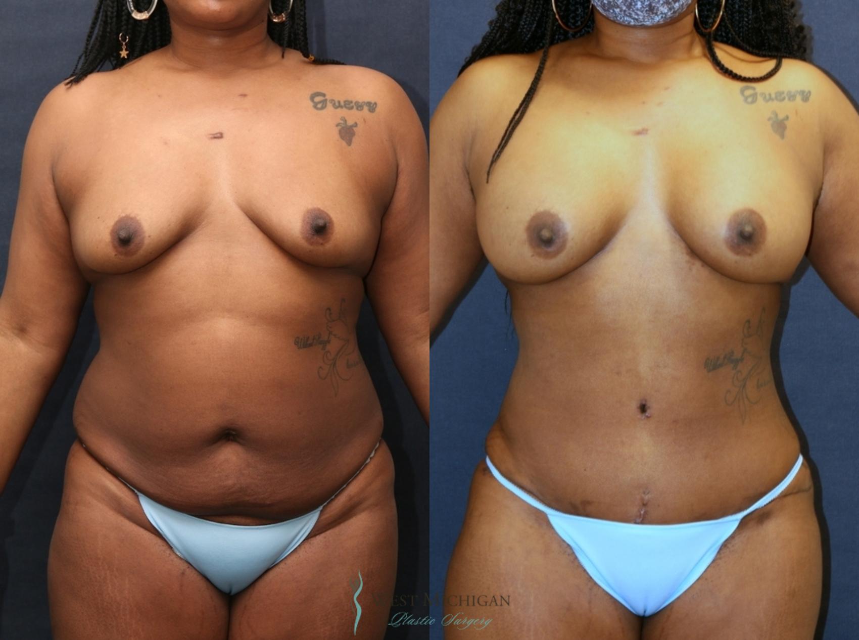 Before & After Mommy Makeover Case 9363 Front View in Kalamazoo & Grand Rapids, Michigan