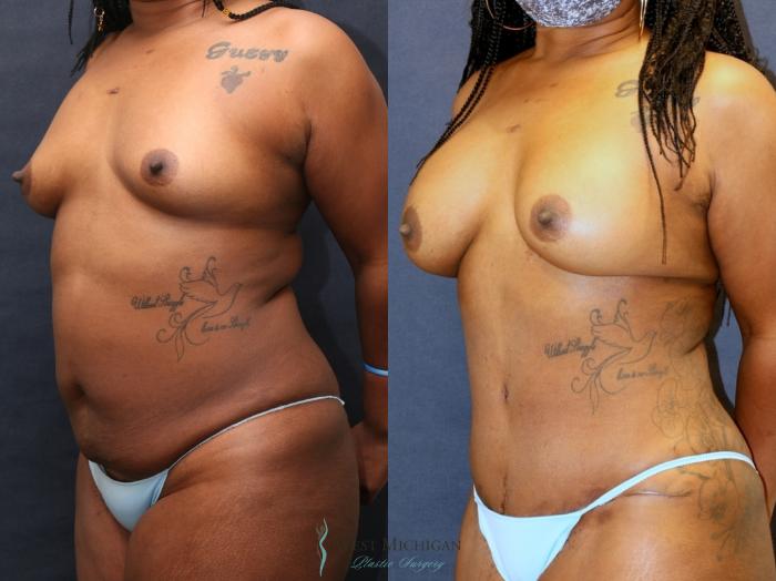 Before & After Mommy Makeover Case 9363 Left Oblique View in Kalamazoo & Grand Rapids, Michigan