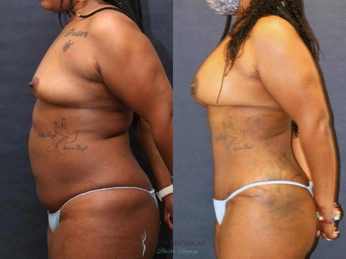 Before & After Mommy Makeover Case 9363 Left Side View in Kalamazoo & Grand Rapids, Michigan