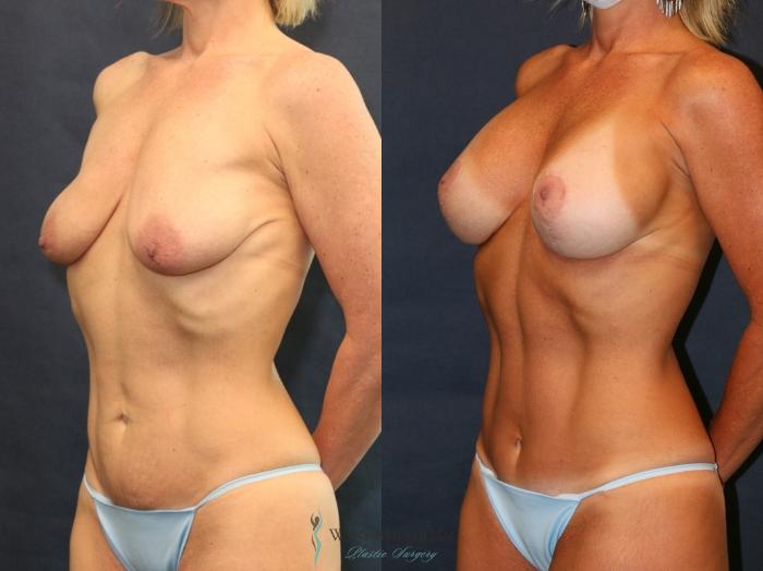 Before & After Mommy Makeover Case 9365 Left Oblique View in Portage, Kalamazoo, Battle Creek, Michigan