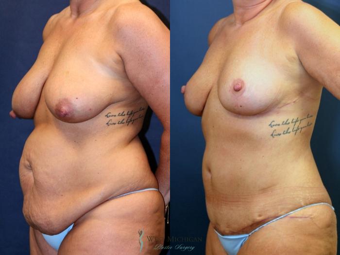 Before & After Mommy Makeover Case 9366 Left Oblique View in Portage, Kalamazoo, Battle Creek, Michigan