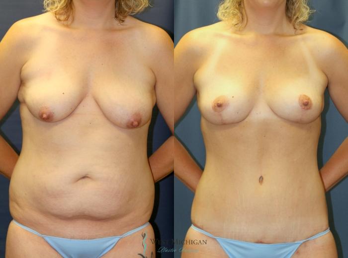 Before & After Mommy Makeover Case 9367 Front View in Kalamazoo & Grand Rapids, Michigan