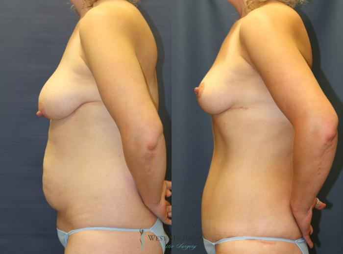 Before & After Mommy Makeover Case 9367 Left Side View in Kalamazoo & Grand Rapids, Michigan