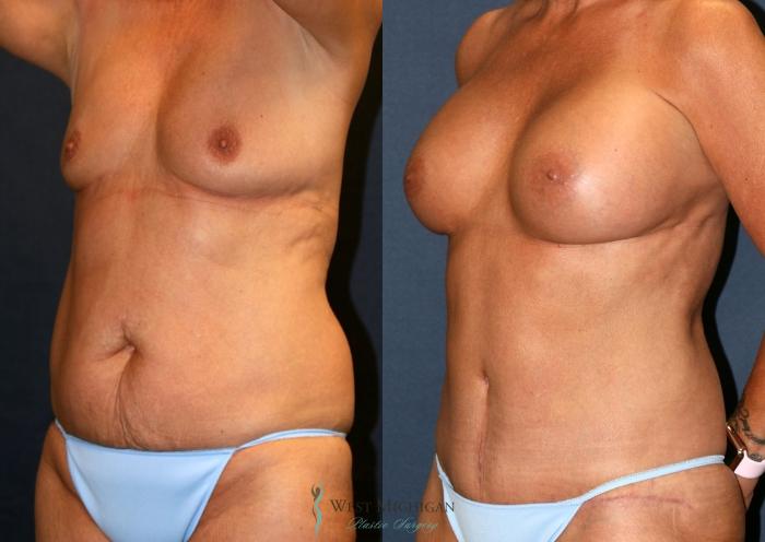 Before & After Mommy Makeover Case 9369 Left Oblique View in Portage, Kalamazoo, Battle Creek, Michigan