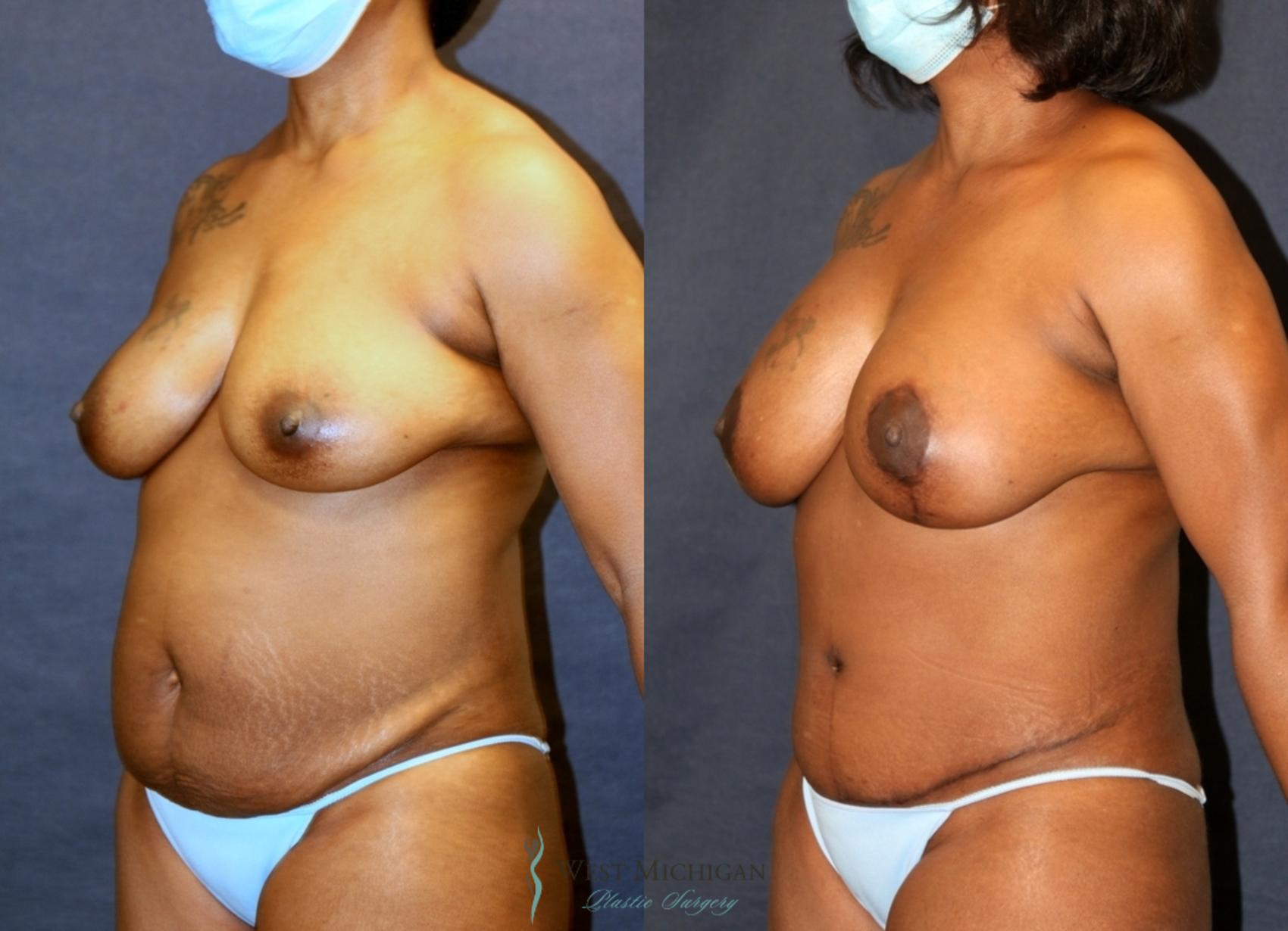 Before & After Mommy Makeover Case 9376 Left Oblique View in Kalamazoo & Grand Rapids, Michigan