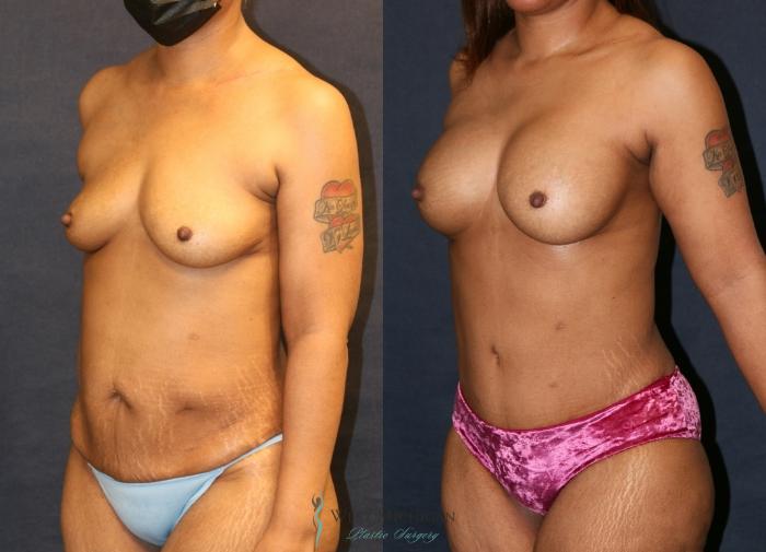 Before & After Mommy Makeover Case 9377 Left Oblique View in Portage, Kalamazoo, Battle Creek, Michigan