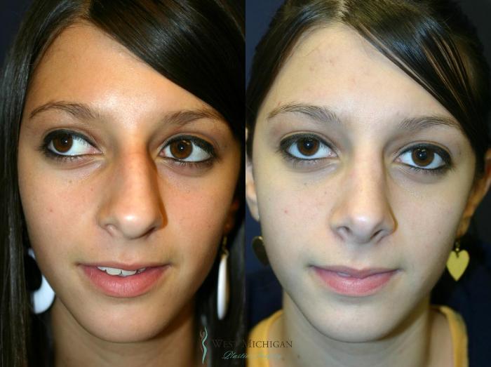 Before & After Nose Surgery Case 8742 View #1 View in Portage, Kalamazoo, Battle Creek, Michigan