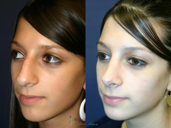 Before & After Nose Surgery Case 8742 View #3 View in Portage, Kalamazoo, Battle Creek, Michigan