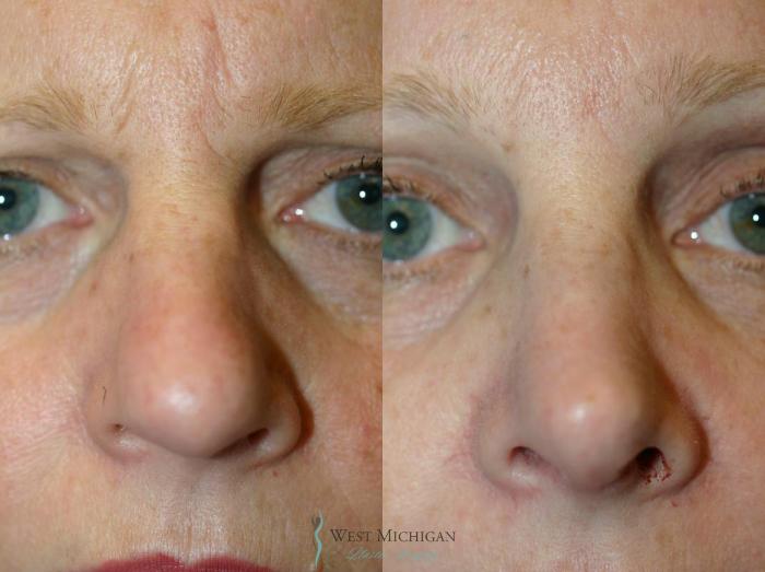 Before & After Nose Surgery Case 8886 View #1 View in Portage, Kalamazoo, Battle Creek, Michigan