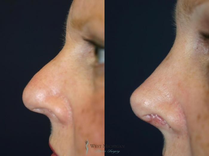 Before & After Nose Surgery Case 8886 View #2 View in Portage, Kalamazoo, Battle Creek, Michigan