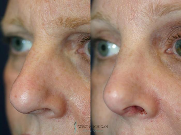 Before & After Nose Surgery Case 8886 View #3 View in Portage, Kalamazoo, Battle Creek, Michigan