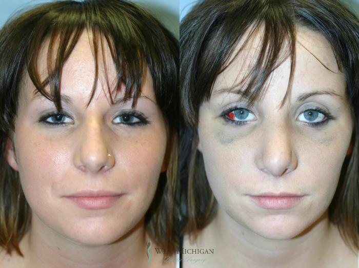 Before & After Nose Surgery Case 8887 View #1 View in Portage, Kalamazoo, Battle Creek, Michigan