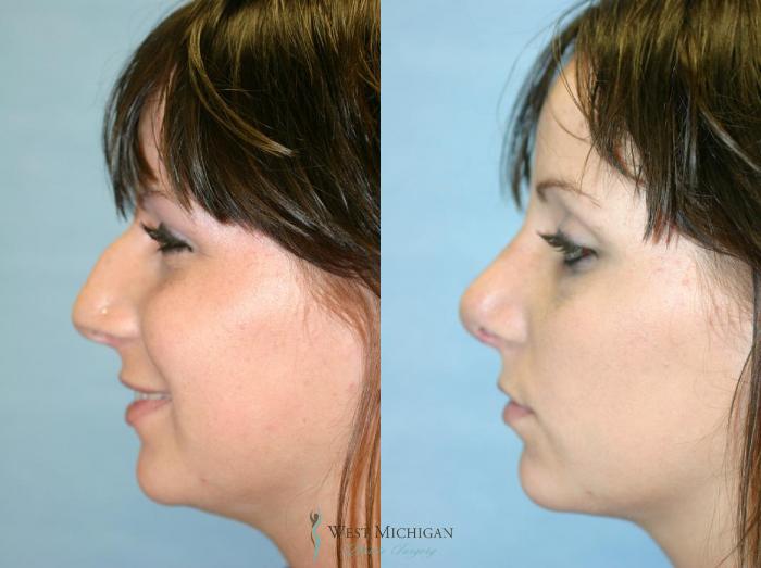 Before & After Nose Surgery Case 8887 View #2 View in Portage, Kalamazoo, Battle Creek, Michigan