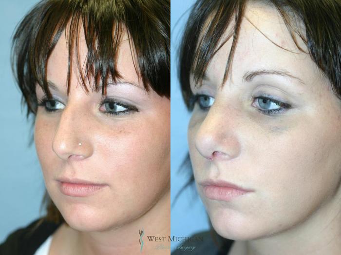 Before & After Nose Surgery Case 8887 View #3 View in Portage, Kalamazoo, Battle Creek, Michigan