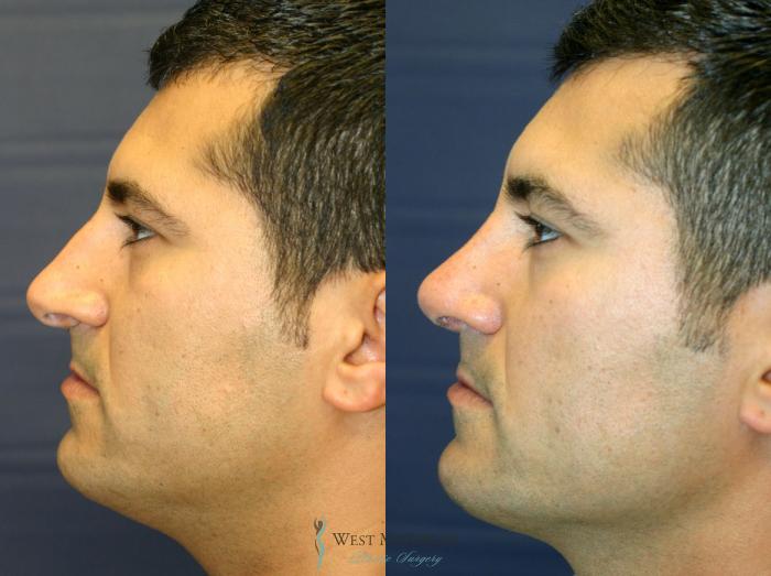 Before & After Nose Surgery Case 8888 View #2 View in Portage, Kalamazoo, Battle Creek, Michigan