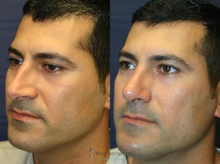 Before & After Nose Surgery Case 8888 View #3 View in Portage, Kalamazoo, Battle Creek, Michigan