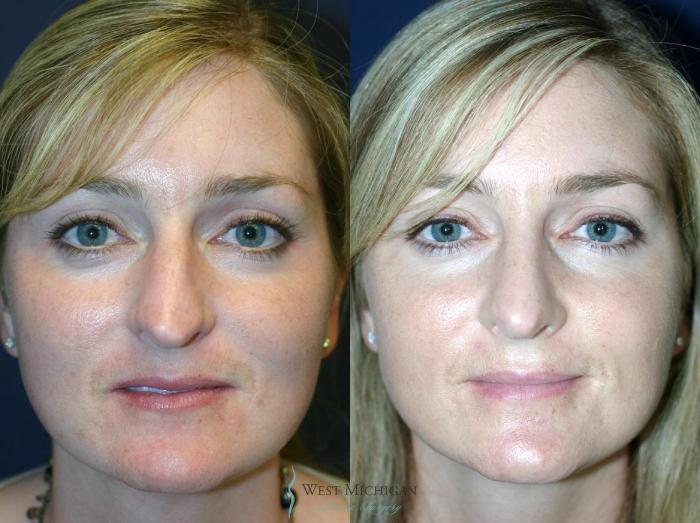 Before & After Nose Surgery Case 8890 View #1 View in Portage, Kalamazoo, Battle Creek, Michigan