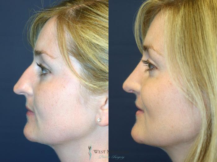 Before & After Nose Surgery Case 8890 View #2 View in Portage, Kalamazoo, Battle Creek, Michigan