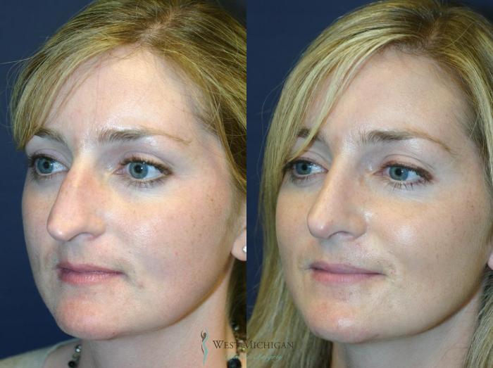 Before & After Nose Surgery Case 8890 View #3 View in Portage, Kalamazoo, Battle Creek, Michigan