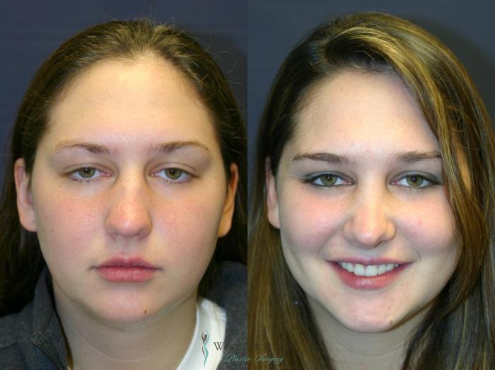 Before & After Nose Surgery Case 8891 View #1 View in Portage, Kalamazoo, Battle Creek, Michigan