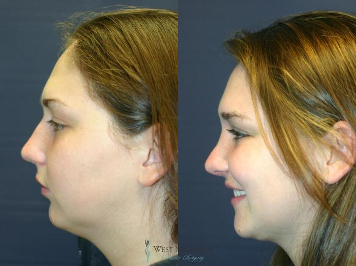 Before & After Nose Surgery Case 8891 View #2 View in Portage, Kalamazoo, Battle Creek, Michigan