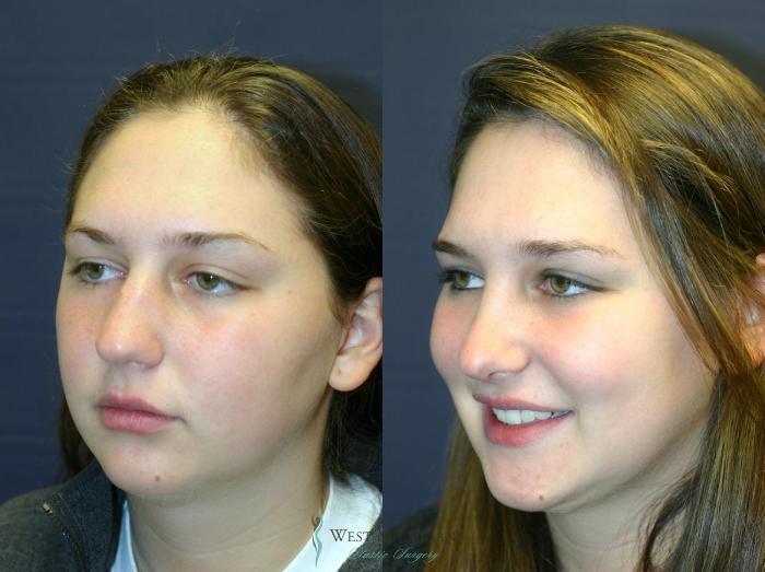 Before & After Nose Surgery Case 8891 View #3 View in Portage, Kalamazoo, Battle Creek, Michigan