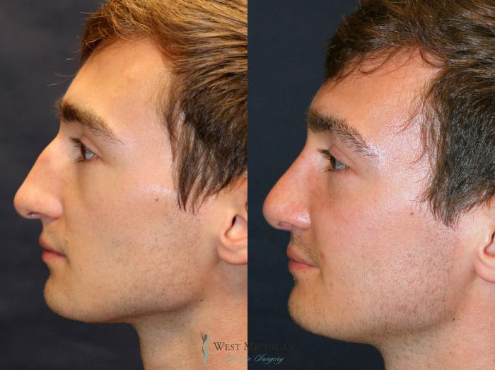 Before & After Nose Surgery Case 8892 View #2 View in Portage, Kalamazoo, Battle Creek, Michigan