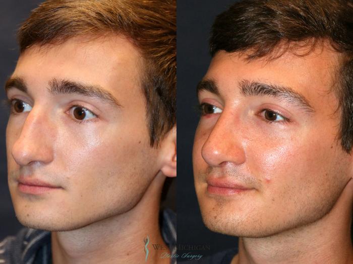 Before & After Nose Surgery Case 8892 View #3 View in Portage, Kalamazoo, Battle Creek, Michigan